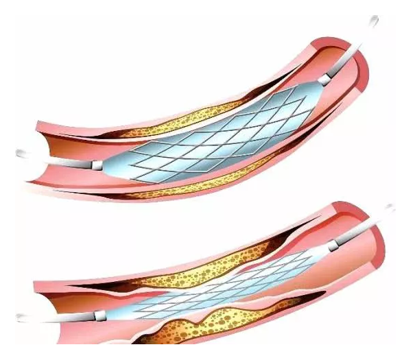 心脏支架真被国外淘汰了吗？真相在这里